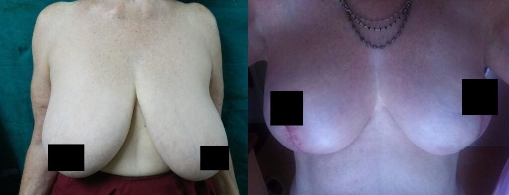 Breast reduction surgery before and after showing reduced breast volume and improved contour