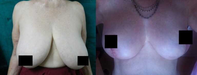 breastlift1