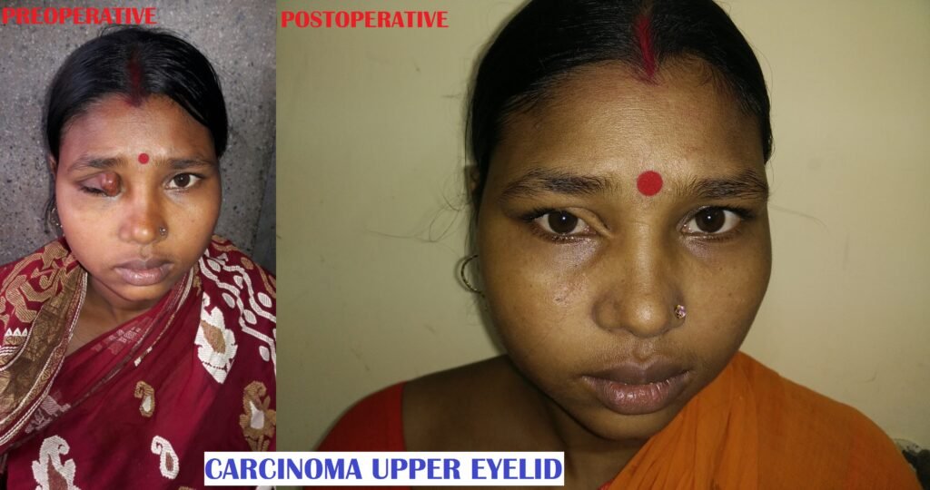 carcinoma eyelid