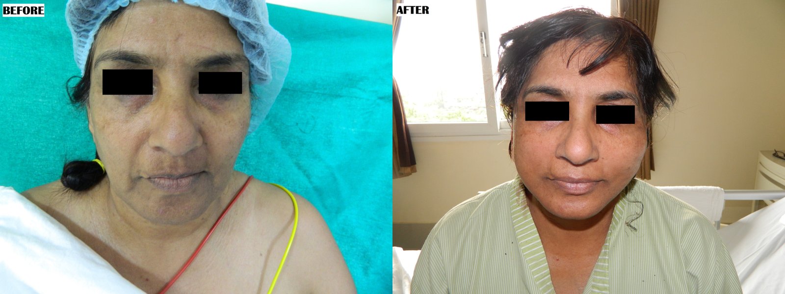 facelift1