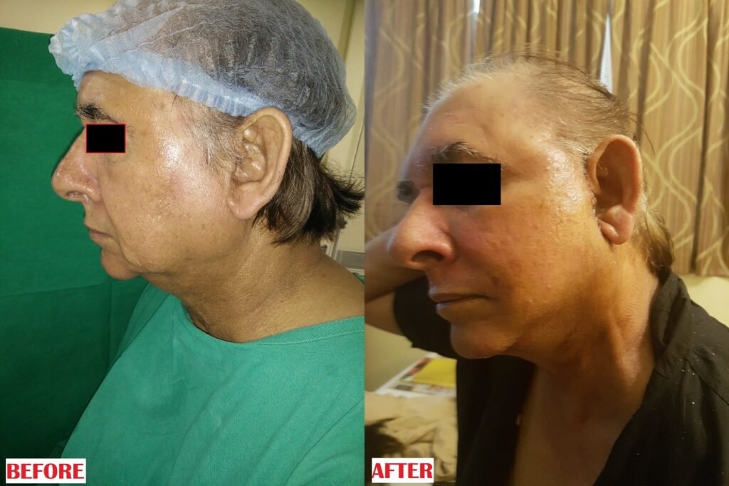 facelift2
