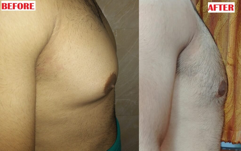 Gynecomastia surgery preoperative and postoperative result