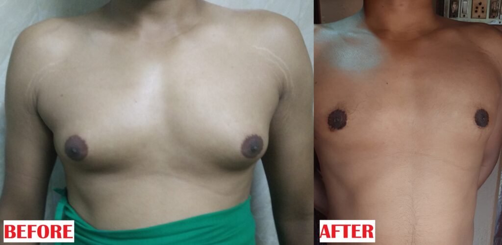 Gynecomastia surgery before and after male chest contouring