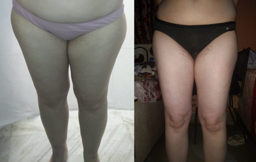 Liposuction of Thighs and Hips Before/After