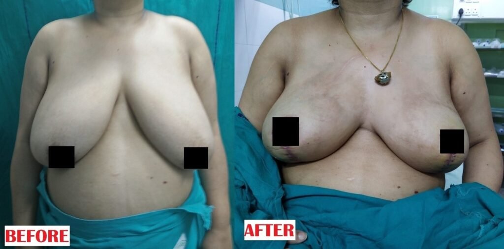 Breast Reduction Surgery Before and After showing reduced volume