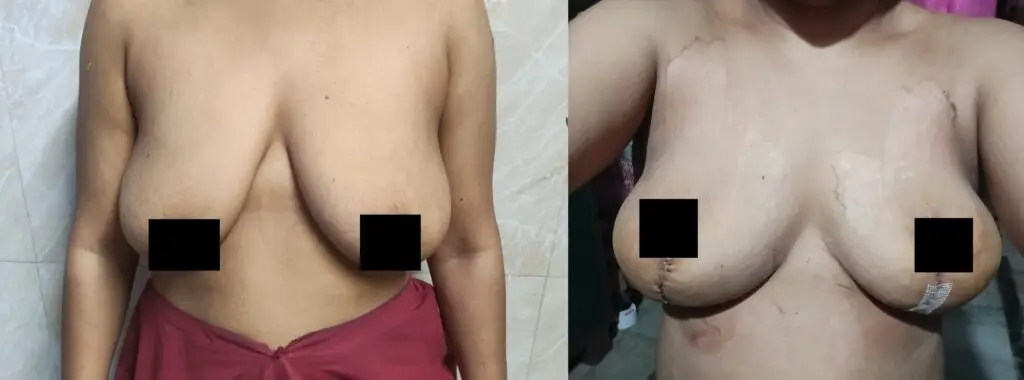 Mastopexy before and after showing improved breast position