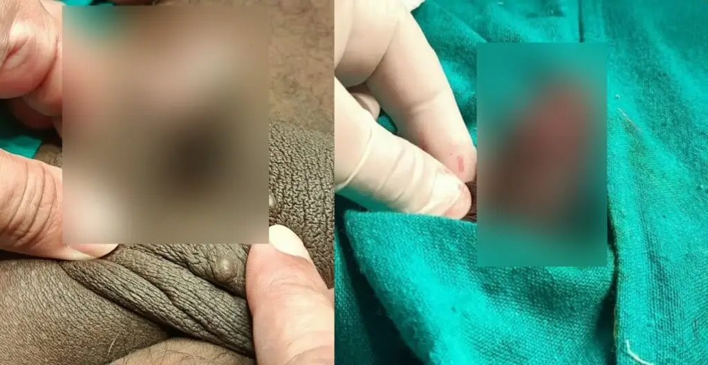 Penile frenuloplasty before and after showing correction of a short penile frenulum