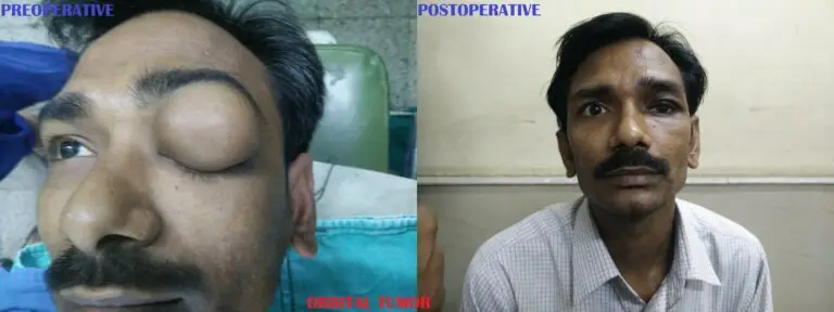 Orbital Tumor Removal Before and After